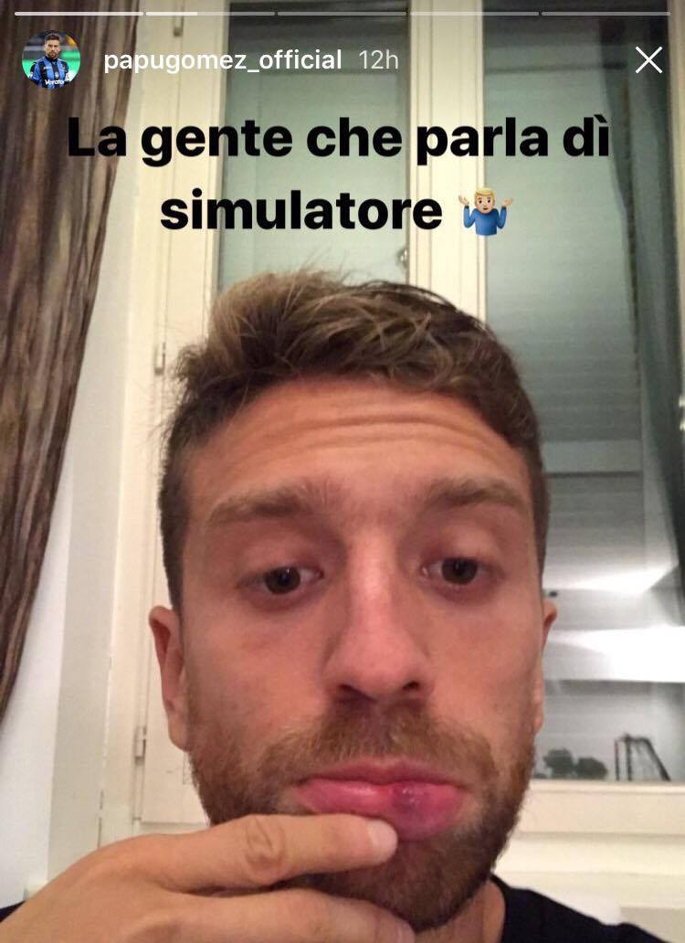 Gomez mostra il taglio provocato da Lichtsteiner: 'Io simulatore...' FOTO